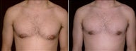 25 year old male, male breast reduction