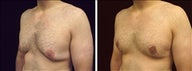 25 year old male, male breast reduction