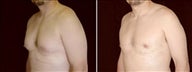 35 year old male, male breast reduction