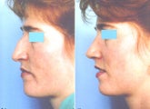 Rhinoplasty