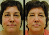 Juvederm