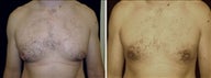 35 year old male, male breast reduction