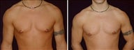 19 year old male, male breast reduction