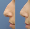 Rhinoplasty