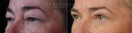 Before and After upper and lower eyelid blepharoplasty