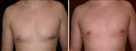 27 year old male, male breast reduction