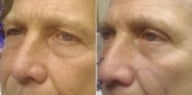 Eye Bags Treatment