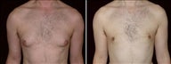 36 year old male, male breast reduction