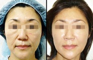 Ultherapy + Fat Transfer