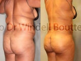 45 Year Old Female Fat Transfer and High Definition Liposuction 