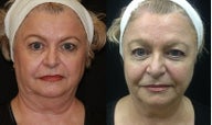 Ultherapy