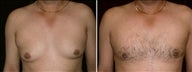 34 year old male, male breast reduction