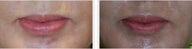 Lip Thinning Reduction