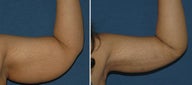 Arm Lift