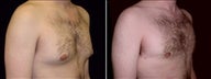 22 year old male, male breast reduction