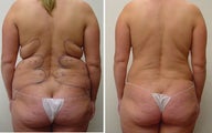 liposuction hips and back