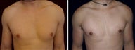 23 year old male, male breast reduction