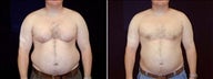 38 year old male, male breast reduction
