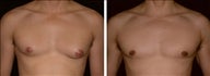28 year old male, male breast reduction