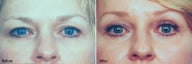 Eyelid Surgery