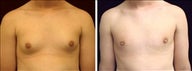 17 year old male, male breast reduction