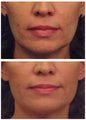 Laser Skin Tightening with acne scar improvement