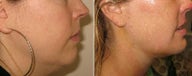 Neck Liposuction and Chin Implant
