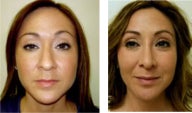 Rhinoplasty