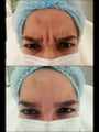 25 yrs old female wit forehead wrinkles