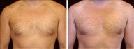 24 year old male, male breast reduction