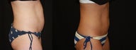Coolsculpting 