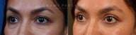 Before and After upper and lower eyelid blepharoplasty
