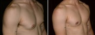24 year old male, male breast reduction