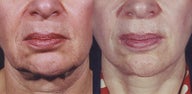 Laser Resurfacing of the face