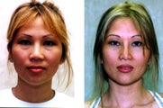 Asian American Rhinoplasty