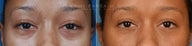 Before and After bilateral lower eyelid blepharoplasty