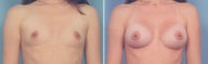 Breast Augmentation