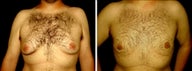 30 year old male, male breast reduction