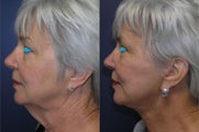 Facelift