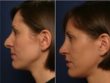 Rhinoplasty revision