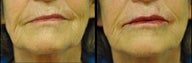 Juvederm and Belotero for Lip Augmentation