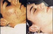 Chemical Peel 