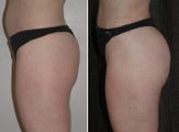 Brazilian Butt Lift
