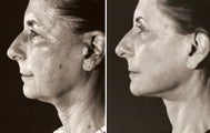 Eyelid Surgery