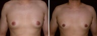 31 year old male, male breast reduction