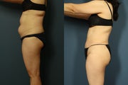 Liposuction to Abdomen and Flanks