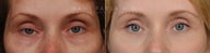 Before and After Bilateral upper eyelid blepharoplasty with  ptosis repair