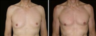 42 year old male, male breast reduction