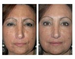 Botox for Frown Lines