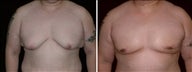 33 year old male, male breast reduction